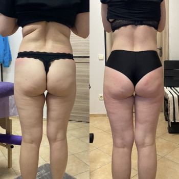 Зроблено 12 сеансів антицелюлітного масажу