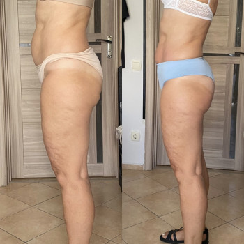 Зроблено 6 сеансів антицелюлітного масажу