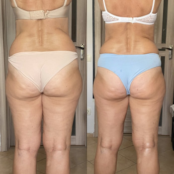 Зменшилась вага та обʼєми Клієнтка (60 років)