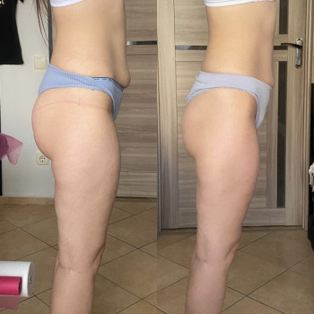 Зроблено 6 сеансів антицелюлітного масажу.Шкіра стала більш пружньою та гладкою,підтягнулися та змен...