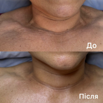 Біоензимна терапія 

1 процедура