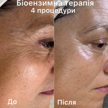 Біоензимна терапія 

4 процедури