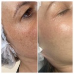 Акція для сяйва та молодості шкіри: Біоревіталізація Jalupro Classic + пілінг для сяйва Jalupro Clow Peel у подарунок! Лікар-косметолог Майя Київ