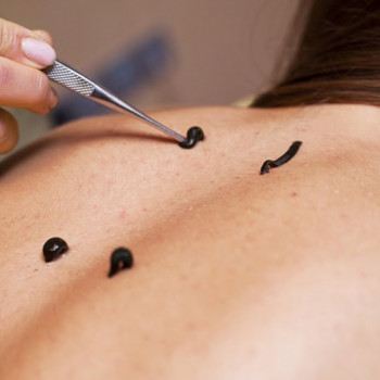 Гірудотерапія