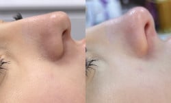 Контурная пластика носа филерами Косметолог-инъекционист Любов Запорожье