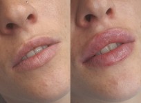 Збільшення губ 1ml Лікар-косметолог Олеся Тернопіль