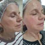 Radiesse Лікар-косметолог Олеся Тернопіль