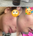 Біоревіталізація шкіри обличчя ExoGlow Массажист Мария Киев