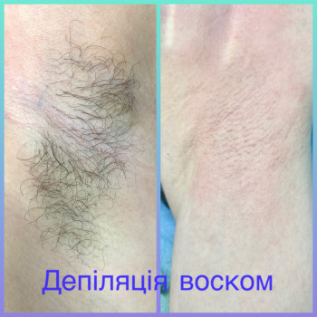 Депіляція пахв