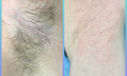 Депиляция подмышек Майстер з пірсингу Татьяна Київ