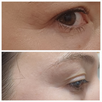 Eye peelling. Пілінг для шкіри навколо очей
                    Мастер депиляции Ирина Киев