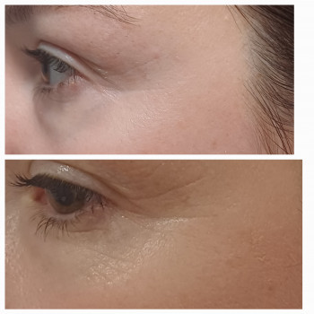 Eye peelling. Пілінг для шкіри навколо очей
                    Мастер депиляции Ирина Киев