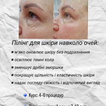 Eye peelling. Пілінг для шкіри навколо очей
                    Мастер депиляции Ирина Киев