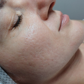 Гарно працює з постакне. Втрівнює рельєф шкіри.