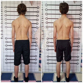 Масаж при сколіозі 1 ступеня
                    Мануальный терапевт Олег Киев