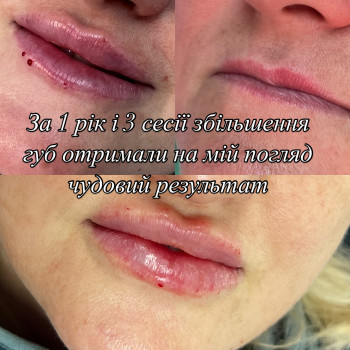 Зробимо губи мрії правильно а не за 1 процедуру 3 мл щоб отримати гіалуроновий балкон