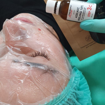 на фото зображено комбіновану чистку обличчя з додаванням азелаїнового пілінгу