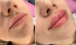 Контурирование губ  - увлажнение и увеличение губ Косметологічний центр Са-Ната Эстетик Київ