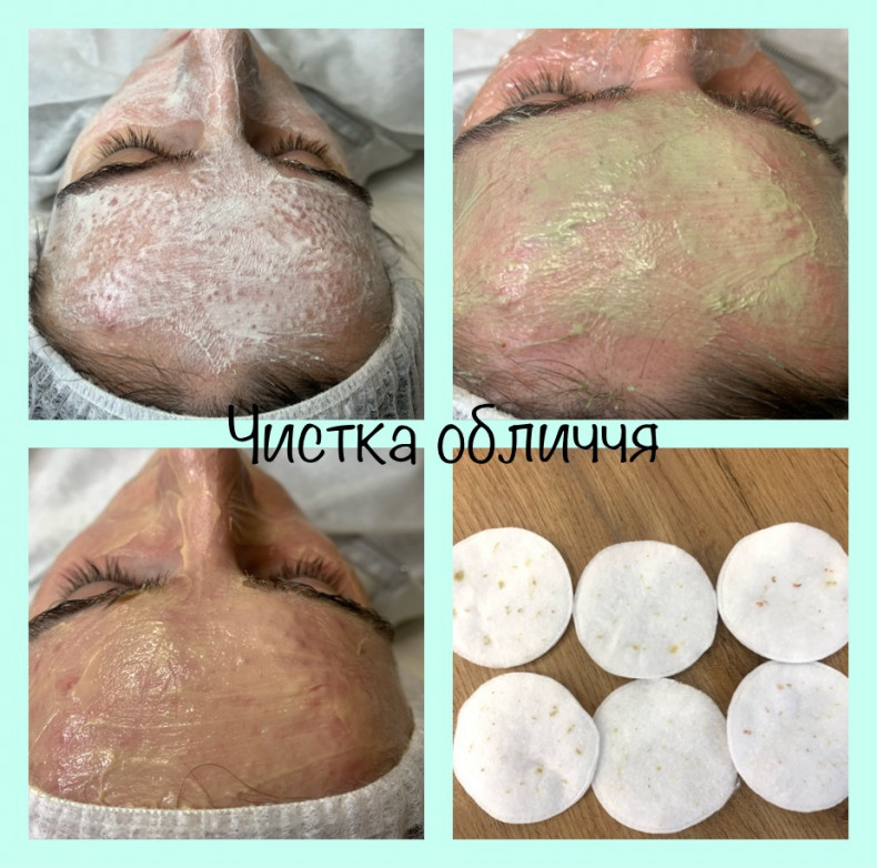 Чистка обличчя комбінована, фото - Мастер по пирсингу Татьяна Ананьева