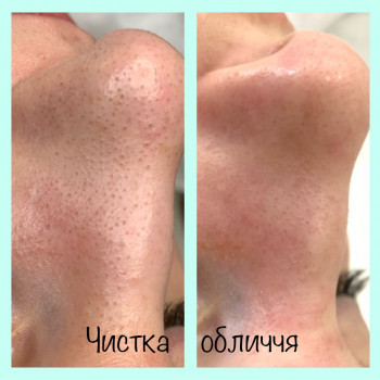 Чистка обличчя комбінована