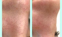 Чистка обличчя Майстер з пірсингу Татьяна Київ