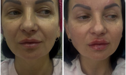 Контурна пластика Radiesse Косметолог-ін'єкціоніст Наталья Дніпро