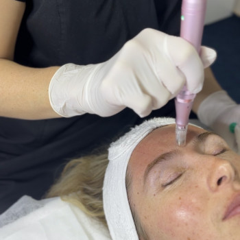 Фракційна мезотерапія. Робота з міжбрівними зморшками.