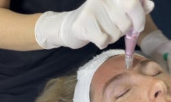 Фракционная мезотерапия. Дермапен. Косметолог Полина Черкаси