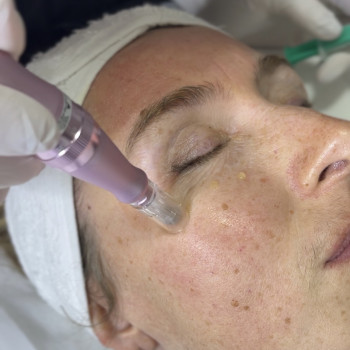 Фракційна мезотерапія. Робота зі зморшками кругом очей.