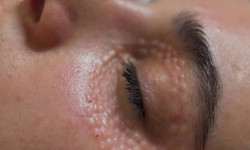 Мезотерапія зони навколо очей препаратом RRS HA Eyes Косметологічний центр Perfect Skin Київ