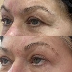 Лазерний ліфтинг повік Дерматолог косметолог Нелли Киев