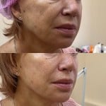 RF-ліфтинг безголковий Дерматолог косметолог Нелли Киев