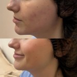 Червоний пілінг на основі гліколевої кислоти Дерматолог косметолог Нелли Киев