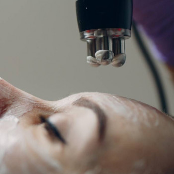 RF ліфтінг обличчя