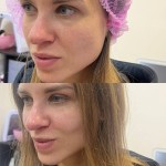 Лавандовий пілінг Дерматолог косметолог Нелли Киев