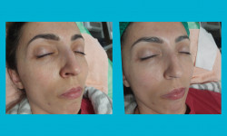 Комбинированная чистка лица Косметолог-естетист Ирина Валерьевна Одеса