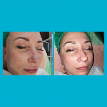  
Миттевий результат після першої процедури