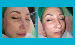 Пилинг ревитализирующий Косметолог-эстетист Ирина Валерьевна Одесса