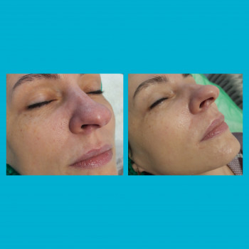   
Мікронідлінг с бустерами для обличчя та губ