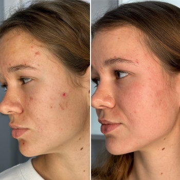 Лікування акне