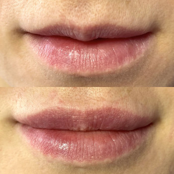 Контурна пластика губ