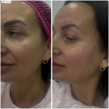 Колагеностимуляція з  Радіесс
                    Косметолог-ін'єкціоніст Наталья Дніпро