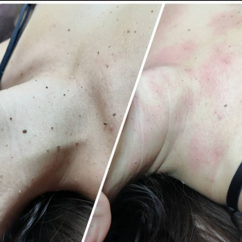 До и После через 15 мин