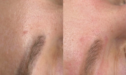 Лазерное удаление татуажа Майстер перманентного макіяжу Анна Буча