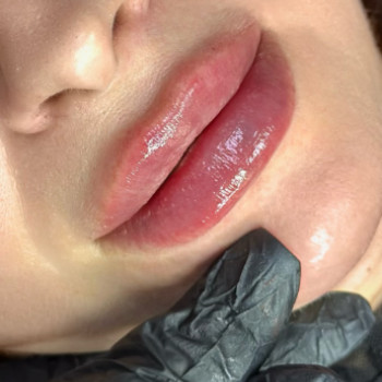 Laser Skin, Павлоград Фото - 5