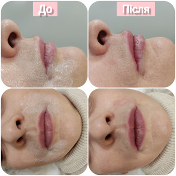 филлер в губы