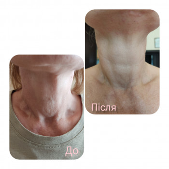 биоревитализация, биоревитализация, биоревитализация кожи