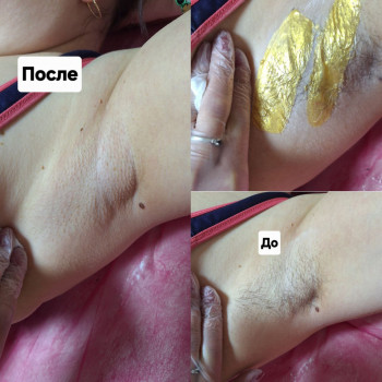 Восковая депиляция