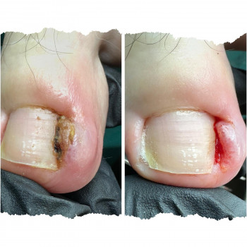 врослий ніготь, тісне взуття.