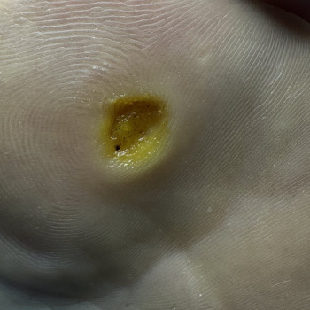 повторна обробка